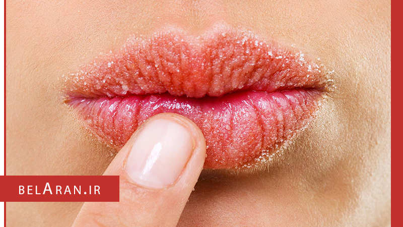 راه حل هایی ساده برای برطرف کردن خشکی و ترک لب - بلاران