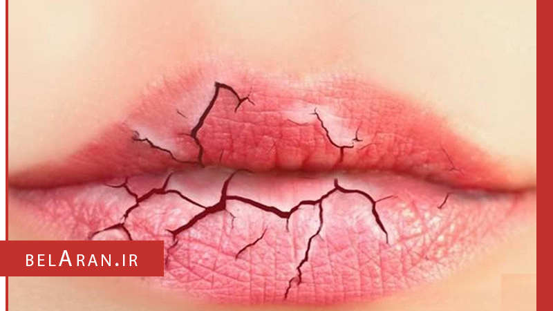 ترک و خشکی لب ها را با روش های خانگی درمان کنید - بلاران
