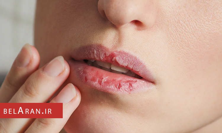 بررسی علل خشک شدن لب ها و نکات مربوط به آن - بلاران