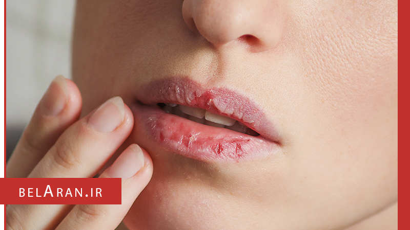 بررسی علل خشک شدن لب ها و نکات مربوط به آن - بلاران
