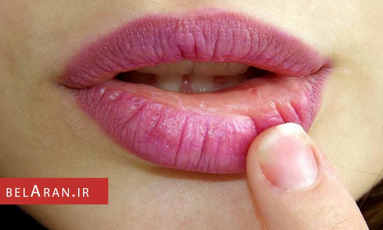 علل خشکی لب ها و ترک خوردن آن ها را بدانیم - بلاران