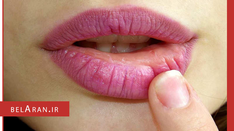 علل خشکی لب ها و ترک خوردن آن ها را بدانیم - بلاران