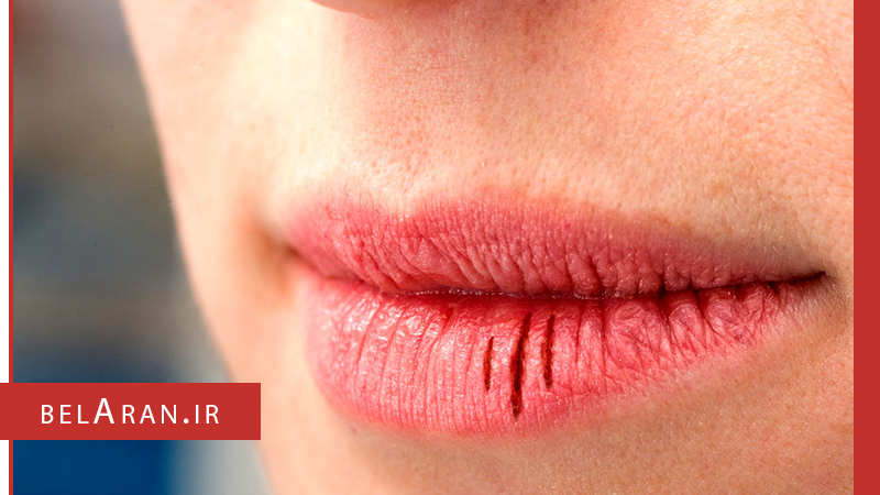 بررسی علل خشک شدن لب ها و نکات مربوط به آن - بلاران