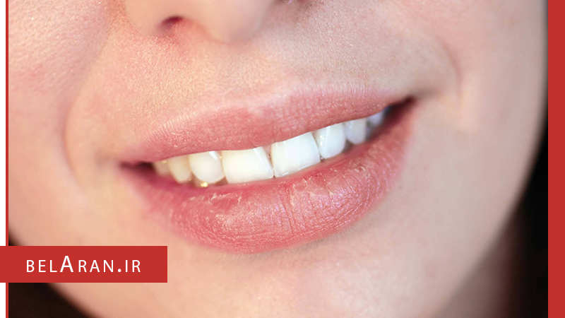 ترک و خشکی لب ها را با روش های خانگی درمان کنید - بلاران