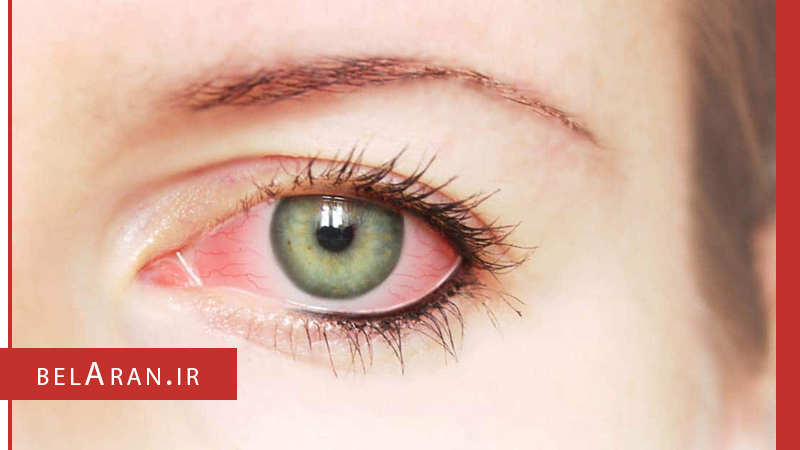 ریمل های فاسد چه آسیب هایی را می توانند به چشم وارد کنند؟ - بلاران
