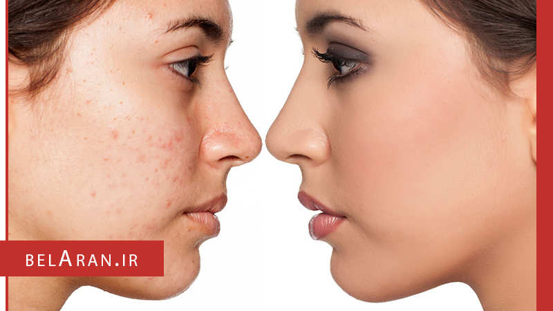 آیا در مورد تی زون صورت چیزی می دانید؟ - بلاران