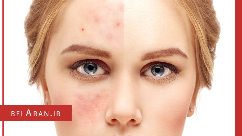 نکات کلیدی برای درمان جوش های بعد اصلاح صورت را بدانیم - بلاران