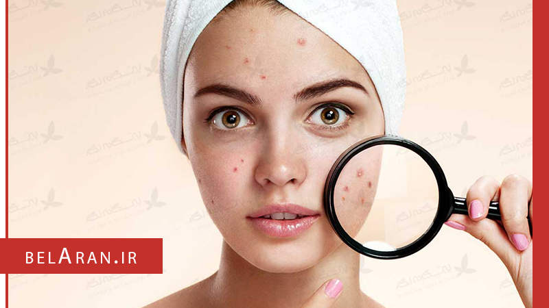 جوش های بعد اصلاح صورت را چگونه درمان کنیم؟ - بلاران