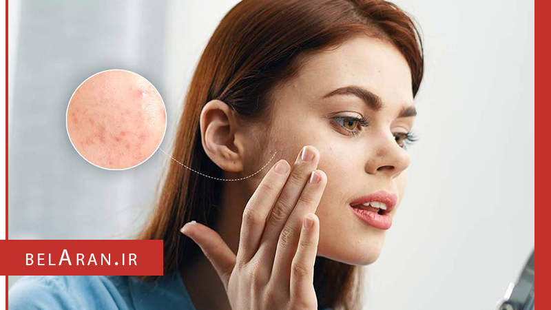 راه هایی برای پیشگیری ازجوش زدن قبل از اصلاح صورت - بلاران