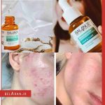 سرم ضد لک و ضد جوش نیاسینامید بالانس Balance Active Skincare Niacinamide Blemish Recovery Serum