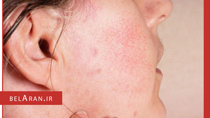 عوارض مصرف بیش از حد تونر پوست را هم بدانیم - بلاران