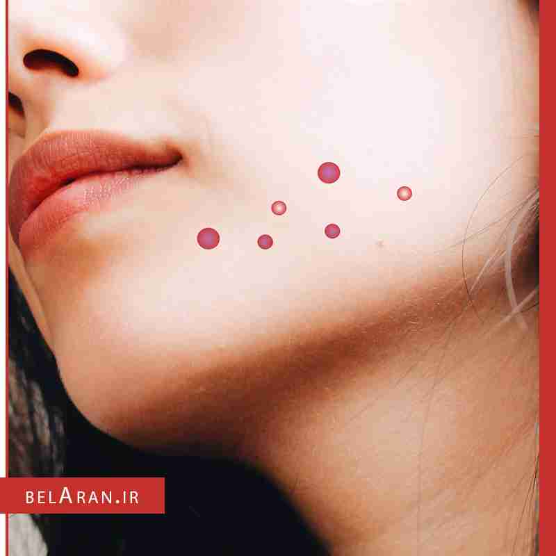 ژل آنتی آکنه و ضد جوش توتال درم TOTAL DERM Anti Acne Gel