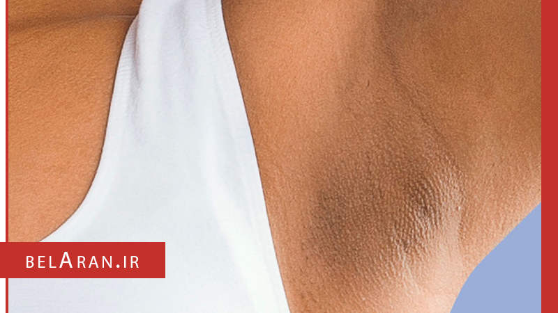 علل و عوامل تیرگی زیر بغل و شناخت راهکارهایی برای آن -بلاران