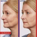 سرم شب ضدچروک لورال رویتالیفت لیزر رتینول-بلاران LOreal Revitalift Laser Pure Retinol Deep Anti-Wrinkle Night Serum