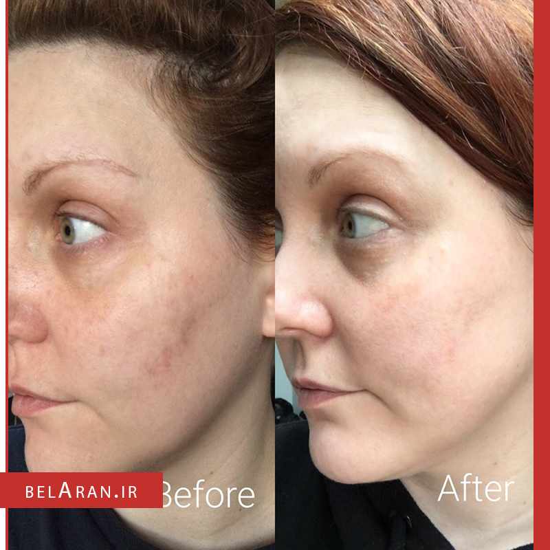 سرم ویتامین سی بالانس اکتیو-index_belaran سرم ویتامین سی بالانس اکتیو Balance Active Formula Vitamin C Brightening Serum