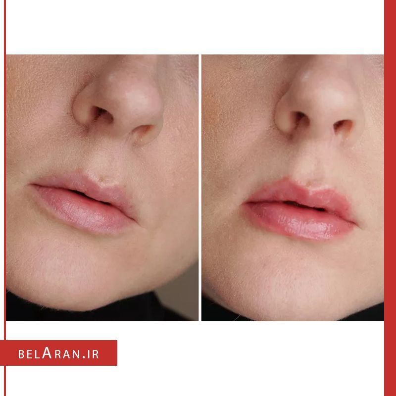 لیپ گلس حجم دهنده توفیسد لیپ اینجکشن اکستریم اینستنلی سکسی-خرید لیپ گلس توفیسد-محصولات توفیسد-خرید لوازم آرایش اورجینال-بلاران-index_belaranlux.com لیپ گلس حجم دهنده توفیسد لیپ اینجکشن اکستریم اینستنلی سکسی-خرید لیپ گلس توفیسد-محصولات توفیسد-خرید لوازم آرایش اورجینال-بلاران Too Faced Lip Injection Extreme Instantly sexy Lip Long Term Lip Plumper belaran